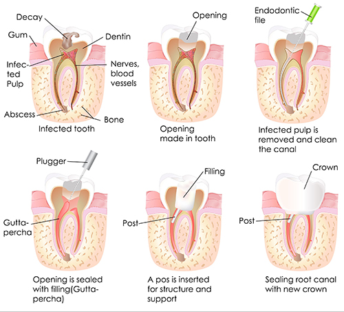 Williamsport root canal
