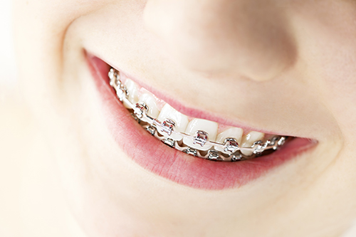 dental braces in Williamsport