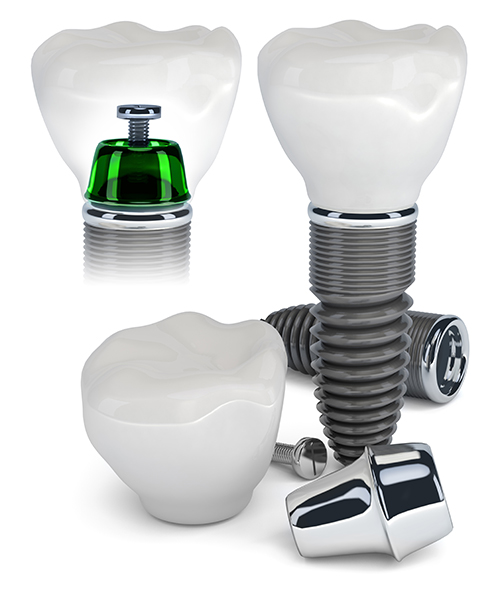 Williamsport dental implants