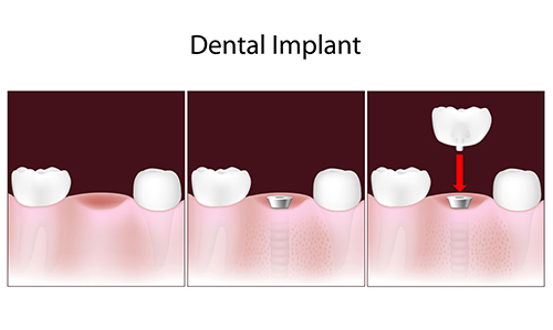 dental implants in Williamsport