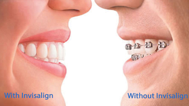 invisalign in Williamsport