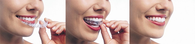 Williamsport invisalign